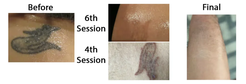 Before and after images of tattoo removal | Reflections Medspa | Lexington, KY