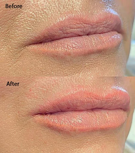 Before and after images of Lip Fillers | Reflections Medspa | Lexington, KY