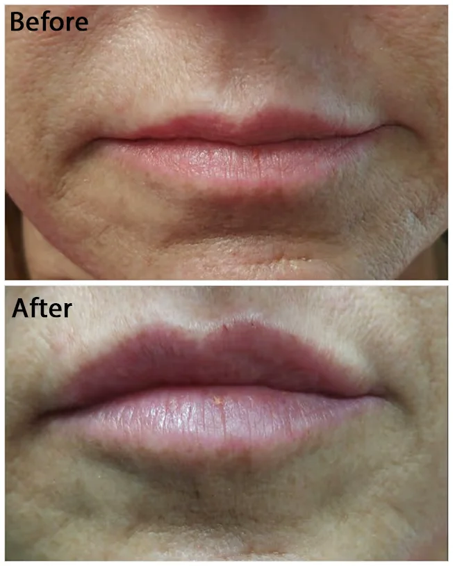 Before and after images of Lip Fillers | Reflections Medspa | Lexington, KY