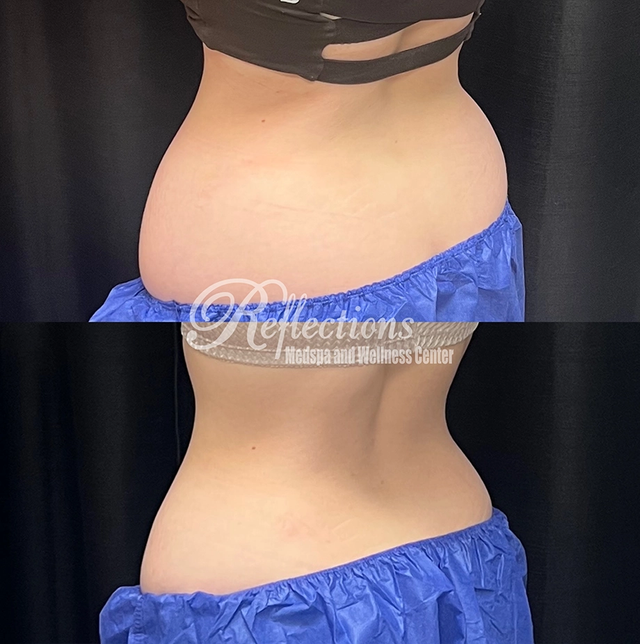 CoolSculpting Elite before and after at Reflections Medspa & Wellness Center