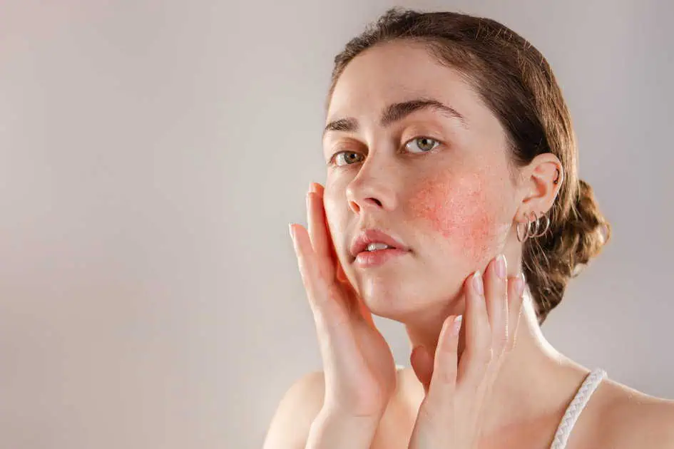 Rosacea Treatment In Lexington, KY by Reflections Medspa And Wellness Center