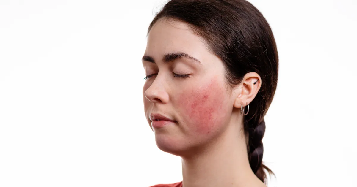 woman with mild rosacea showing redness on cheeks in Lexington, KY