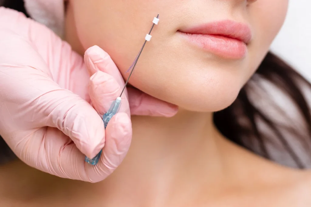 Patient receiving a PDO thread lift for face and neck rejuvenation to improve jawline definition and skin firmness.